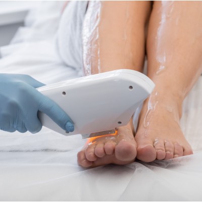 Hands and Feet Laser Hair Removal Treatment