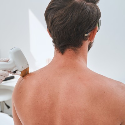 ShouldersLaser Hair Removal Treatment